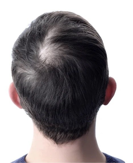 Before using Halo Fibers - Thinning hair